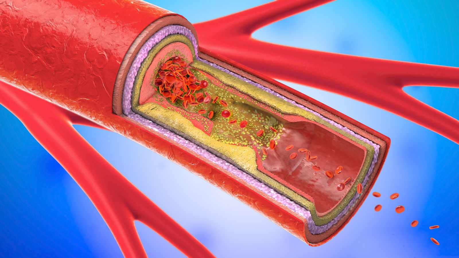 how-serious-is-a-mild-narrowing-of-the-carotid-artery-harvard-health